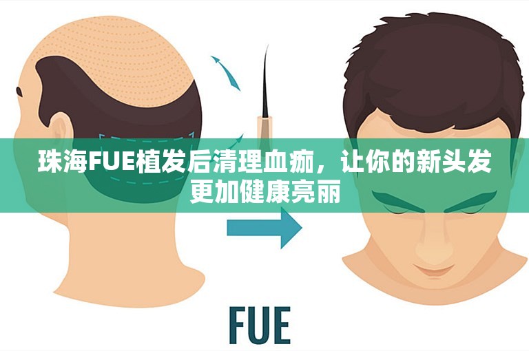 珠海FUE植发后清理血痂，让你的新头发更加健康亮丽