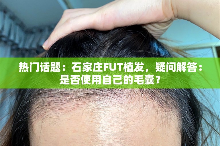 热门话题：石家庄FUT植发，疑问解答：是否使用自己的毛囊？