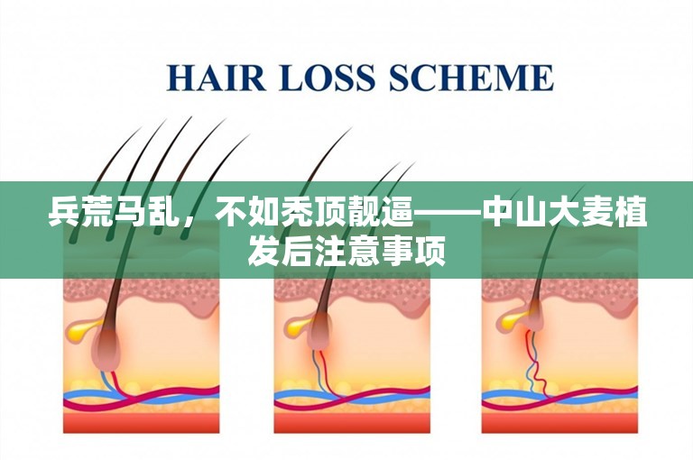 兵荒马乱，不如秃顶靓逼——中山大麦植发后注意事项