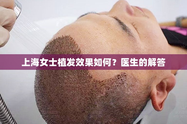 上海女士植发效果如何？医生的解答