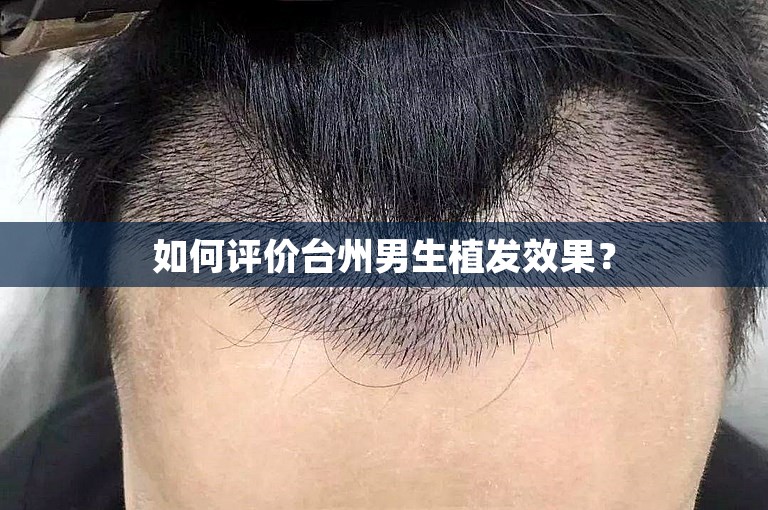 如何评价台州男生植发效果？