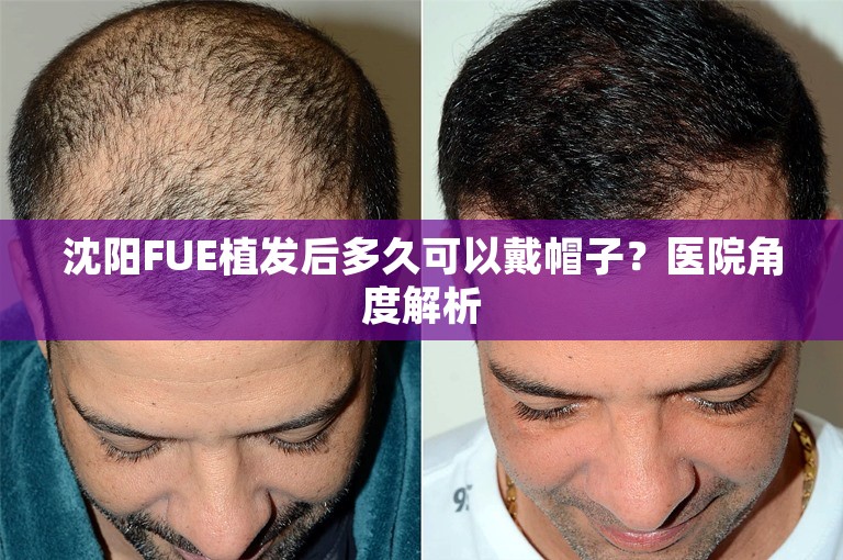 沈阳FUE植发后多久可以戴帽子？医院角度解析