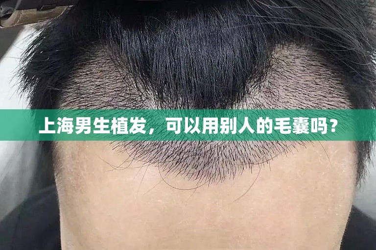 上海男生植发，可以用别人的毛囊吗？