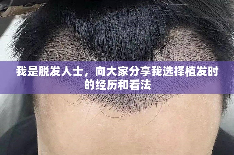 我是脱发人士，向大家分享我选择植发时的经历和看法