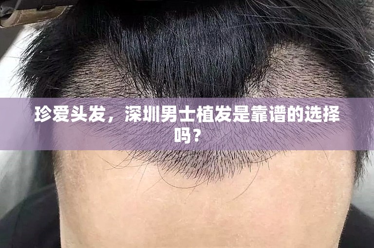 珍爱头发，深圳男士植发是靠谱的选择吗？