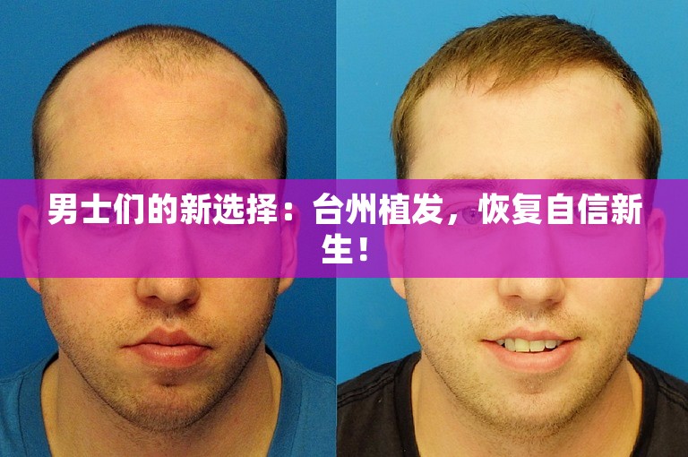 男士们的新选择：台州植发，恢复自信新生！