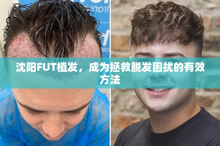 沈阳FUT植发，成为拯救脱发困扰的有效方法