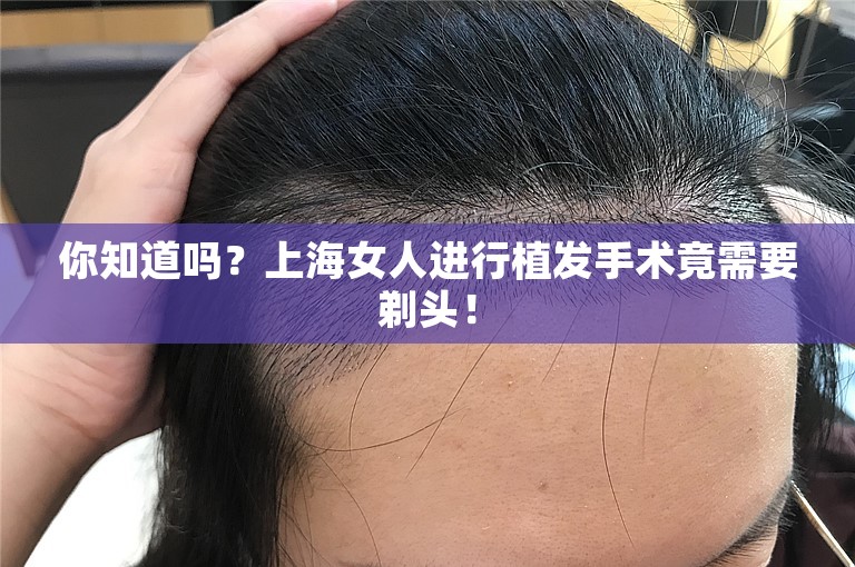 你知道吗？上海女人进行植发手术竟需要剃头！