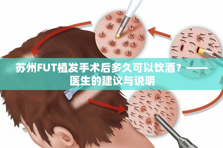 苏州FUT植发手术后多久可以饮酒？——医生的建议与说明