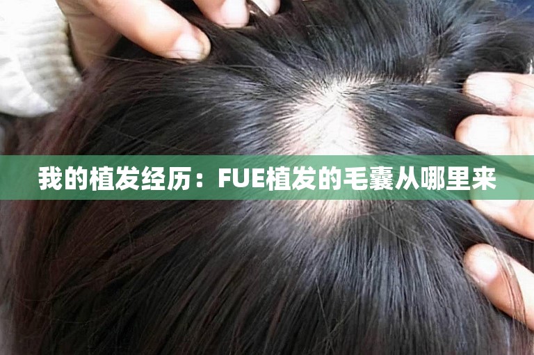 我的植发经历：FUE植发的毛囊从哪里来