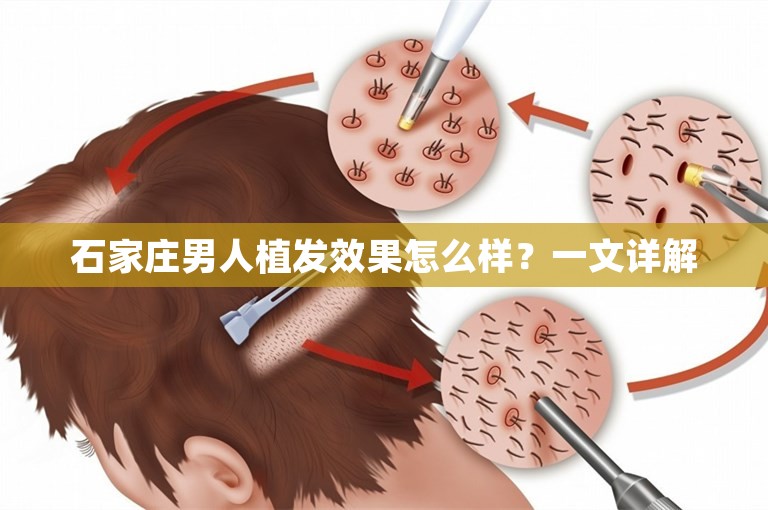 石家庄男人植发效果怎么样？一文详解