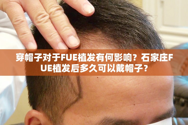 穿帽子对于FUE植发有何影响？石家庄FUE植发后多久可以戴帽子？