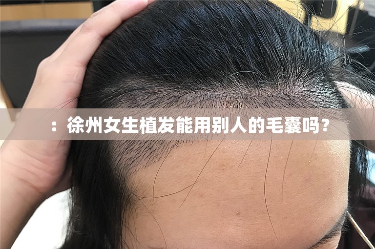 ：徐州女生植发能用别人的毛囊吗？