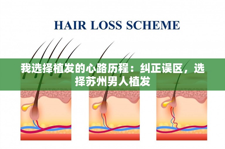 我选择植发的心路历程：纠正误区，选择苏州男人植发