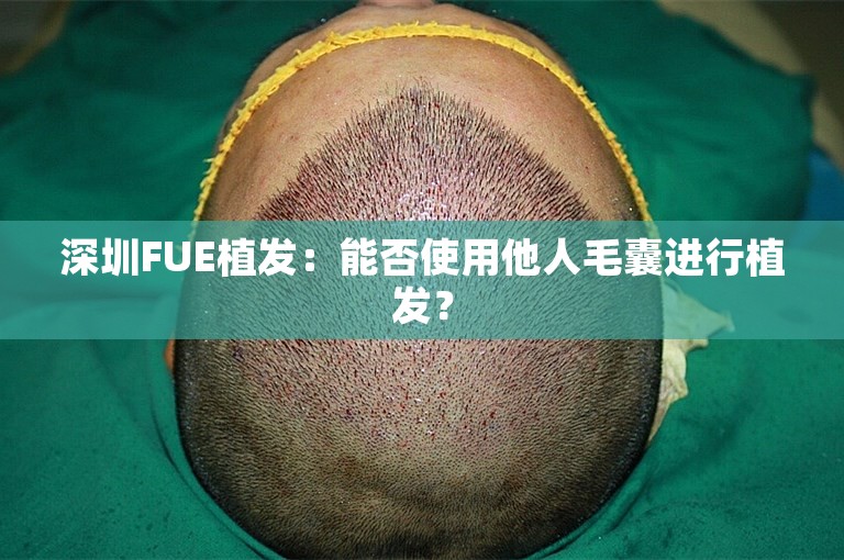 深圳FUE植发：能否使用他人毛囊进行植发？