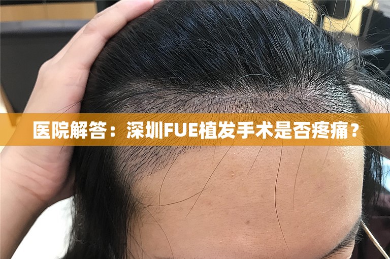 医院解答：深圳FUE植发手术是否疼痛？