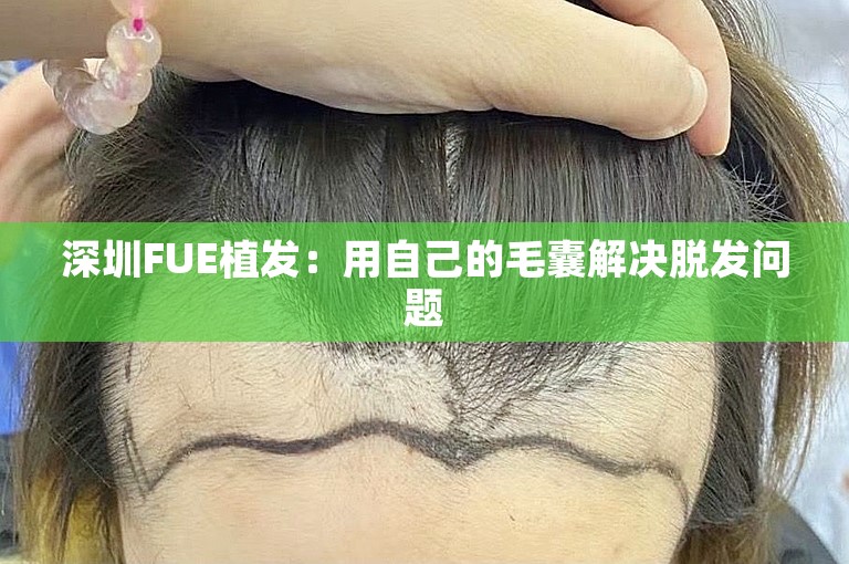 深圳FUE植发：用自己的毛囊解决脱发问题