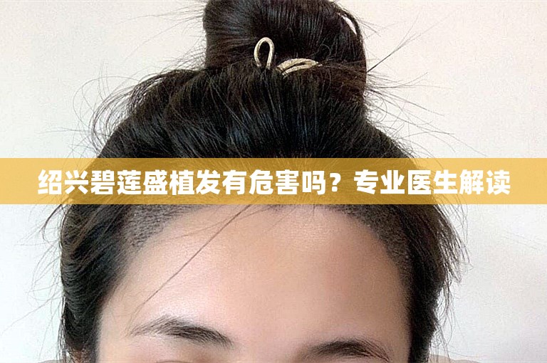 绍兴碧莲盛植发有危害吗？专业医生解读