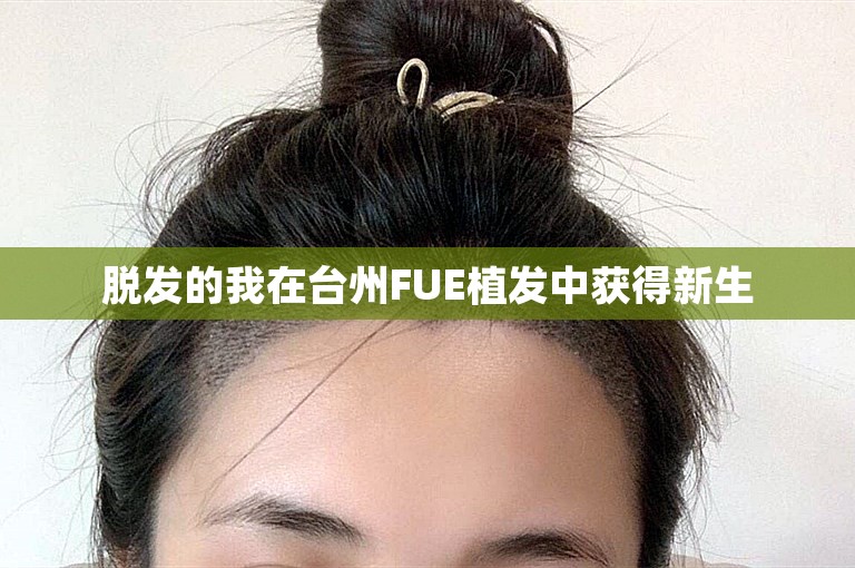 脱发的我在台州FUE植发中获得新生