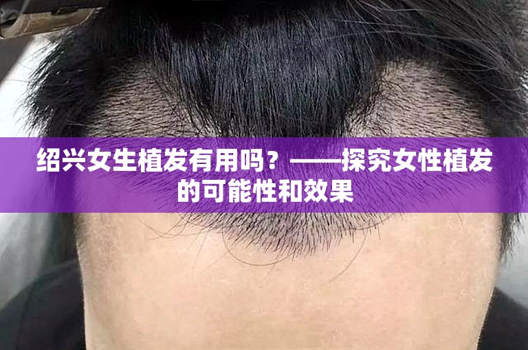 绍兴女生植发有用吗？——探究女性植发的可能性和效果