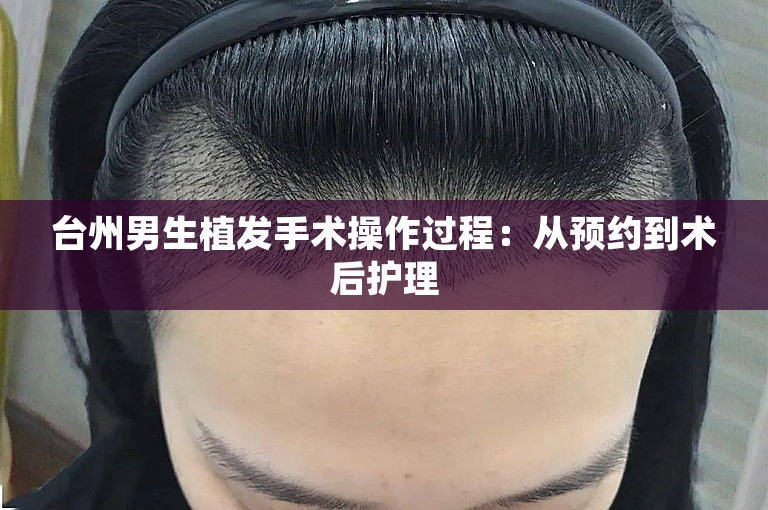 台州男生植发手术操作过程：从预约到术后护理