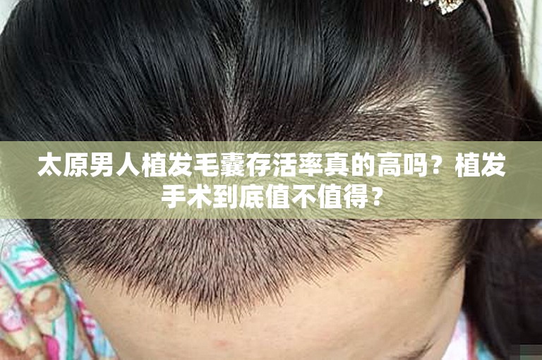 太原男人植发毛囊存活率真的高吗？植发手术到底值不值得？