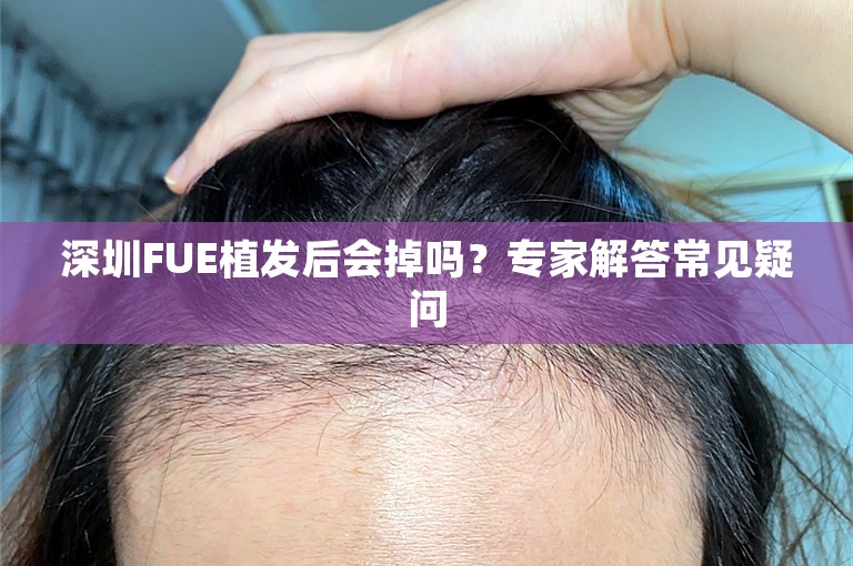 深圳FUE植发后会掉吗？专家解答常见疑问