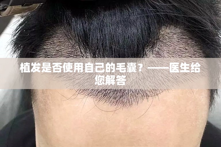 植发是否使用自己的毛囊？——医生给您解答