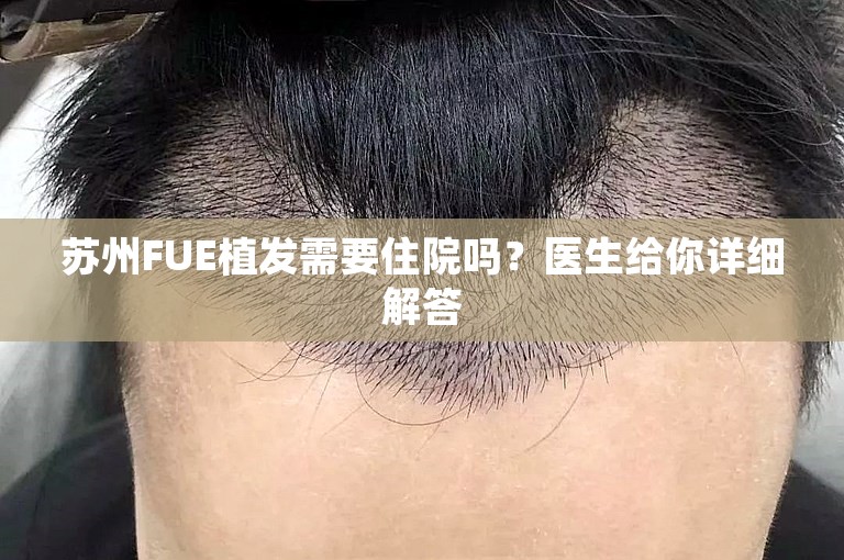 苏州FUE植发需要住院吗？医生给你详细解答