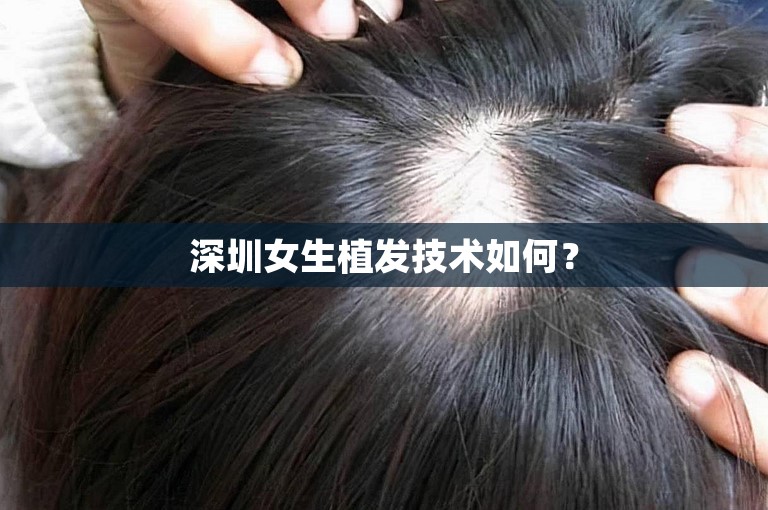 深圳女生植发技术如何？