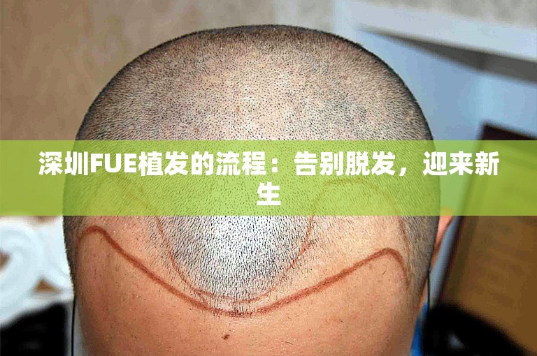 深圳FUE植发的流程：告别脱发，迎来新生