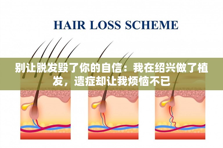 别让脱发毁了你的自信：我在绍兴做了植发，遗症却让我烦恼不已