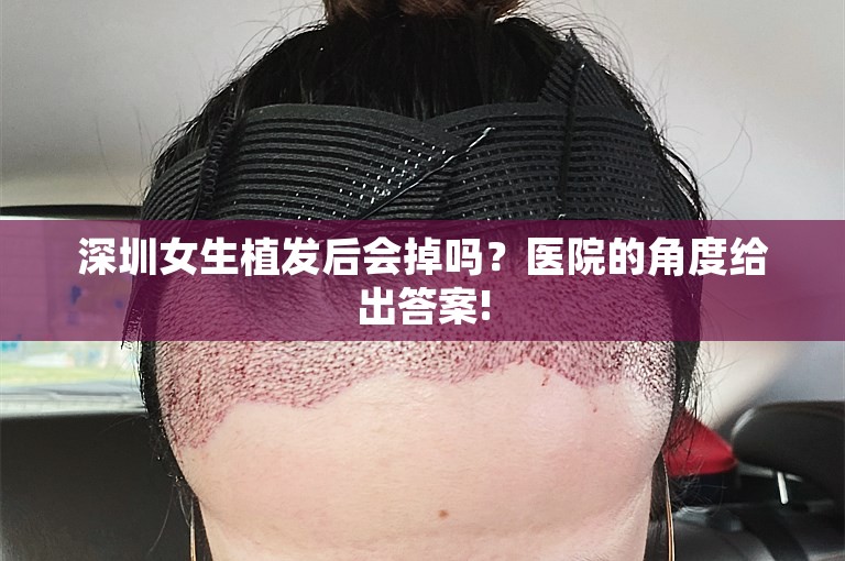 深圳女生植发后会掉吗？医院的角度给出答案!