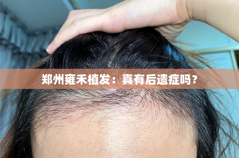 郑州雍禾植发：真有后遗症吗？