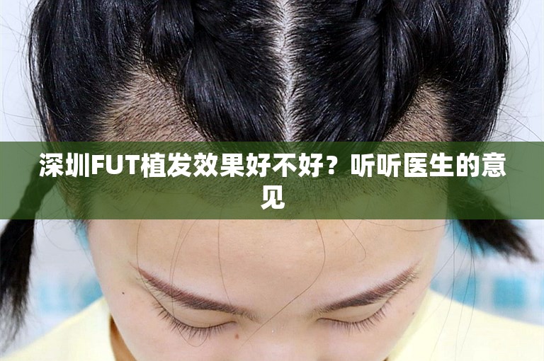 深圳FUT植发效果好不好？听听医生的意见