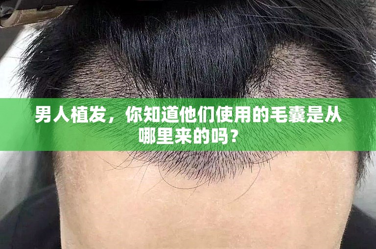 男人植发，你知道他们使用的毛囊是从哪里来的吗？