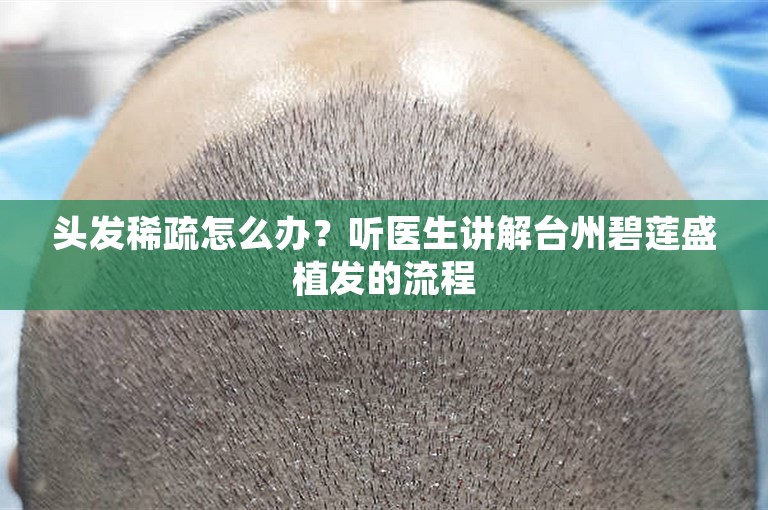 头发稀疏怎么办？听医生讲解台州碧莲盛植发的流程