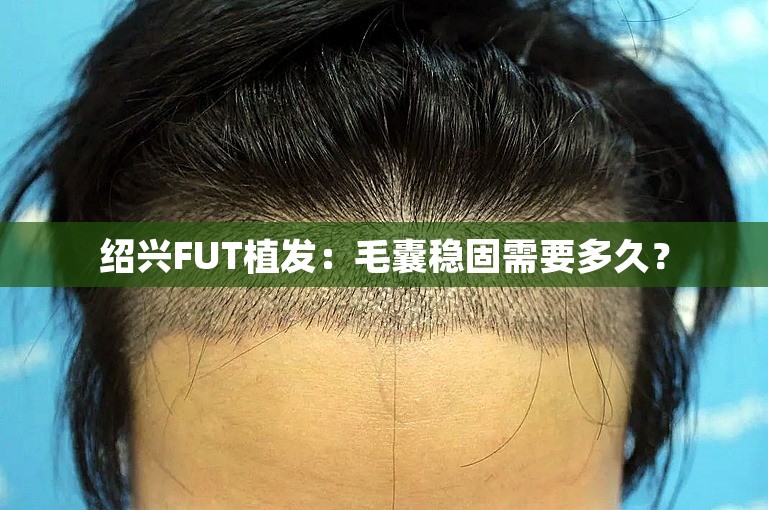 绍兴FUT植发：毛囊稳固需要多久？