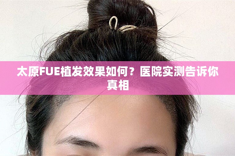 太原FUE植发效果如何？医院实测告诉你真相