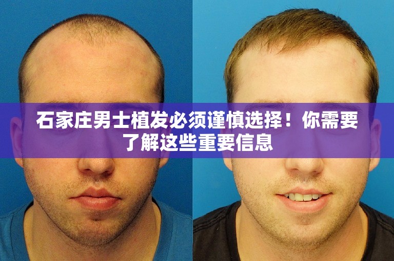 石家庄男士植发必须谨慎选择！你需要了解这些重要信息