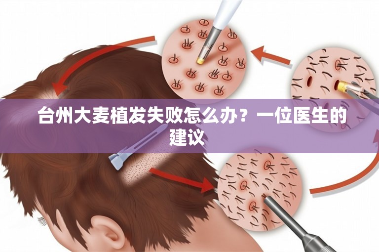  台州大麦植发失败怎么办？一位医生的建议 