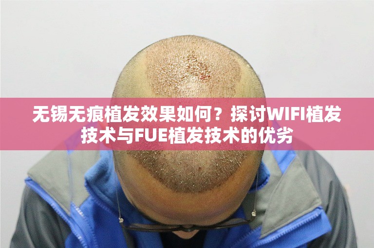 无锡无痕植发效果如何？探讨WIFI植发技术与FUE植发技术的优劣