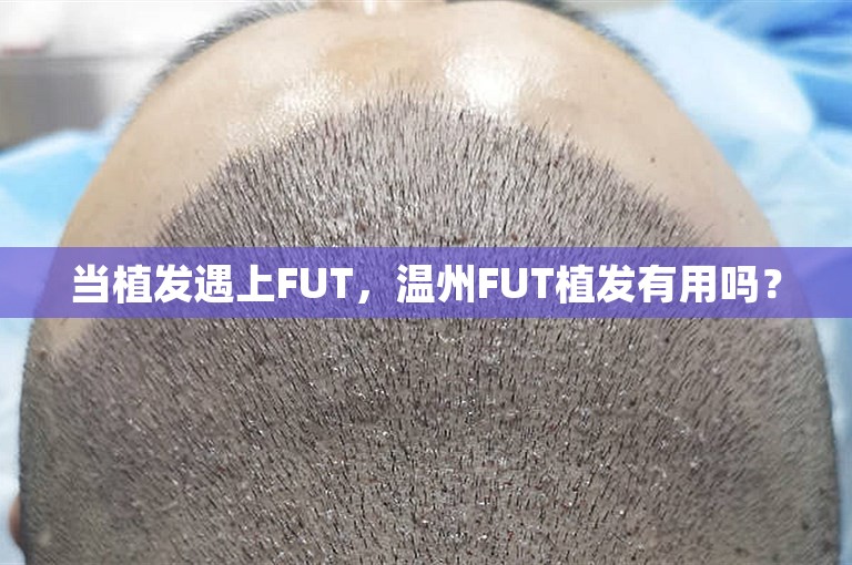 当植发遇上FUT，温州FUT植发有用吗？