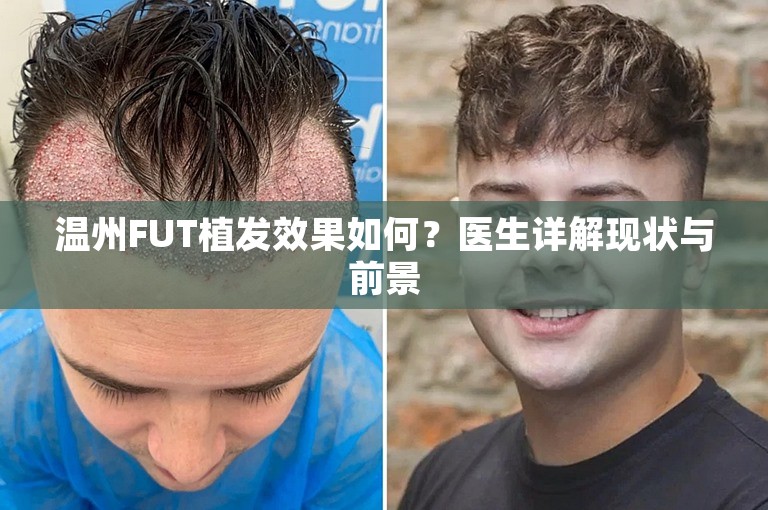 温州FUT植发效果如何？医生详解现状与前景