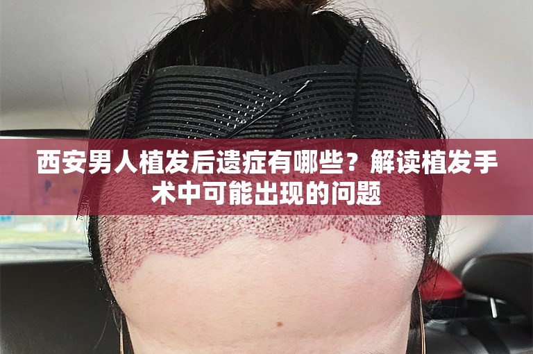 西安男人植发后遗症有哪些？解读植发手术中可能出现的问题