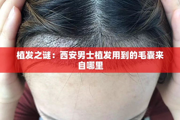 植发之谜：西安男士植发用到的毛囊来自哪里