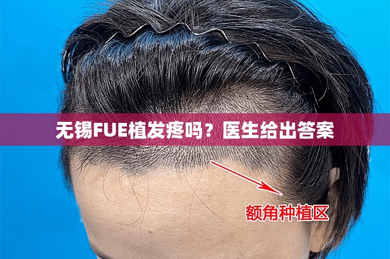 无锡FUE植发疼吗？医生给出答案