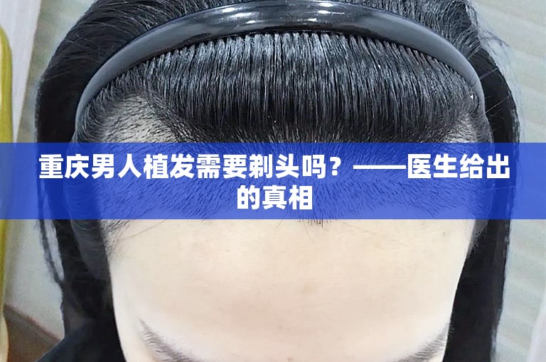 重庆男人植发需要剃头吗？——医生给出的真相