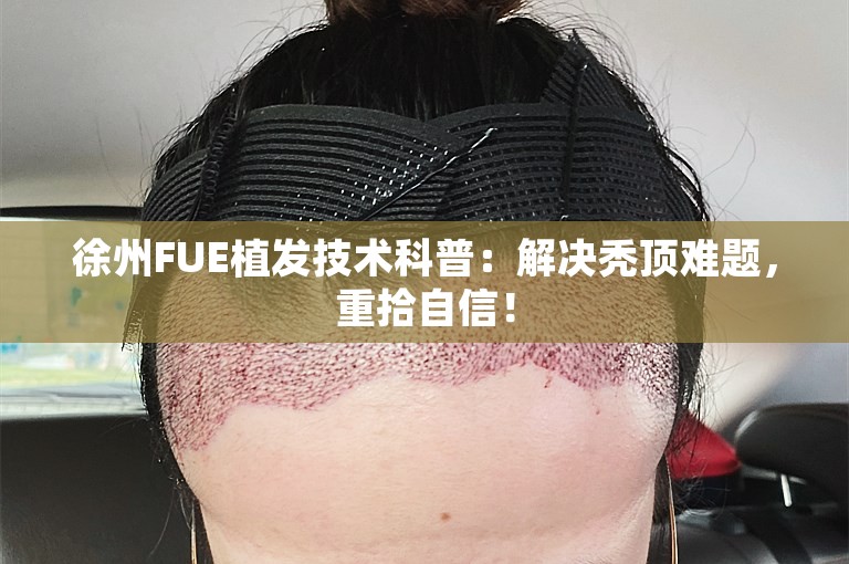 徐州FUE植发技术科普：解决秃顶难题，重拾自信！