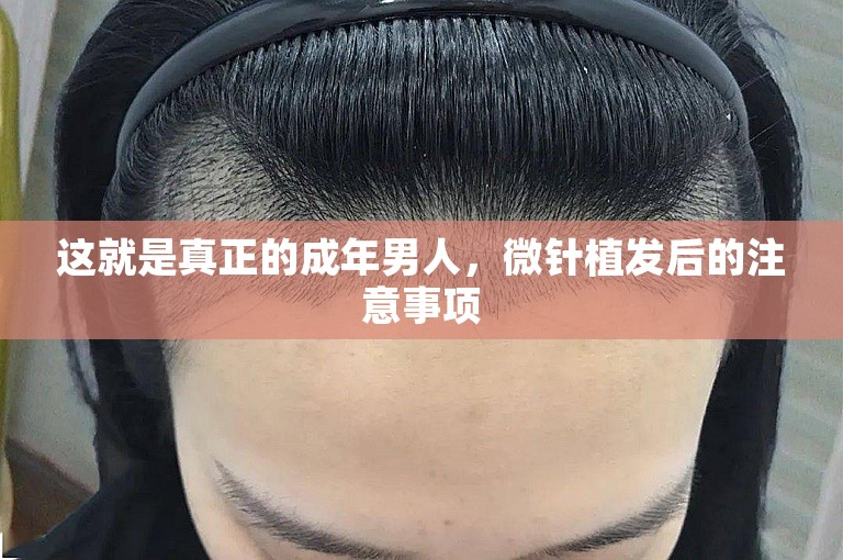 这就是真正的成年男人，微针植发后的注意事项